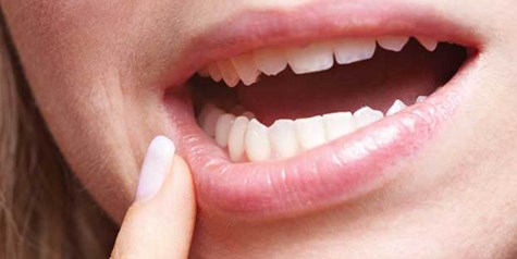 آفت دهان را سه سوته با طب سنتی درمان کنید + راهکار